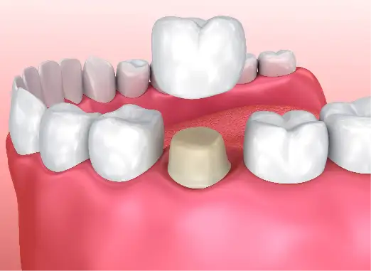 Dental Crowns & Bridges